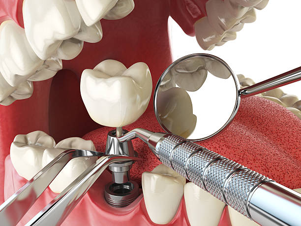 Best Urgent Care for Lost Fillings or Crowns in Liverpool, NY